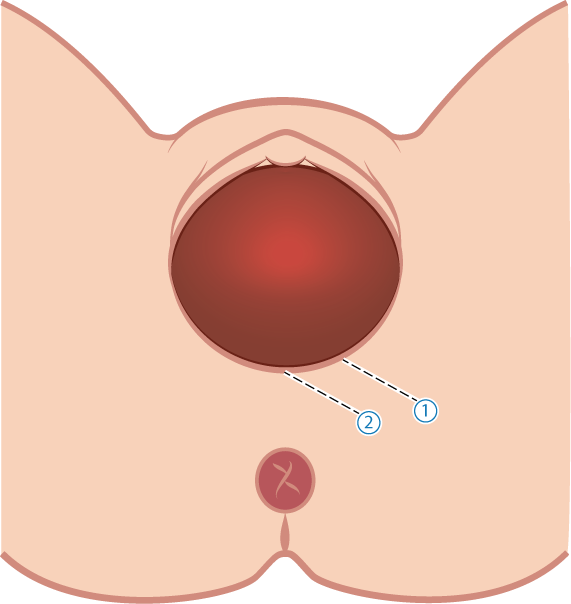 Lateralt och mediolateralt klipp.png