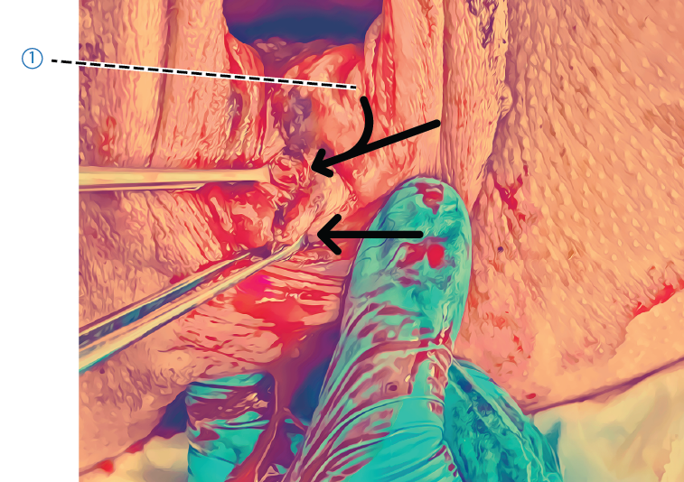  Mellangrdsmusklerna 2